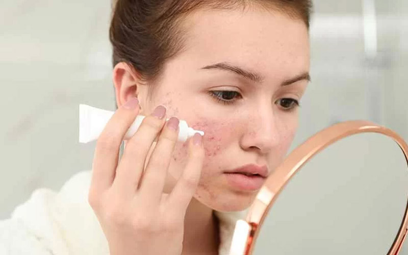 بهترین ضد آفتاب برای پوست جوش دار