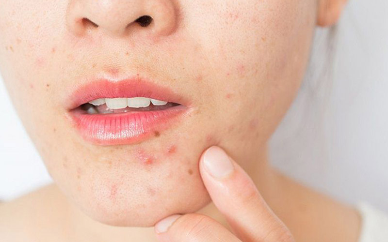 بهترین پماد برای جوش صورت