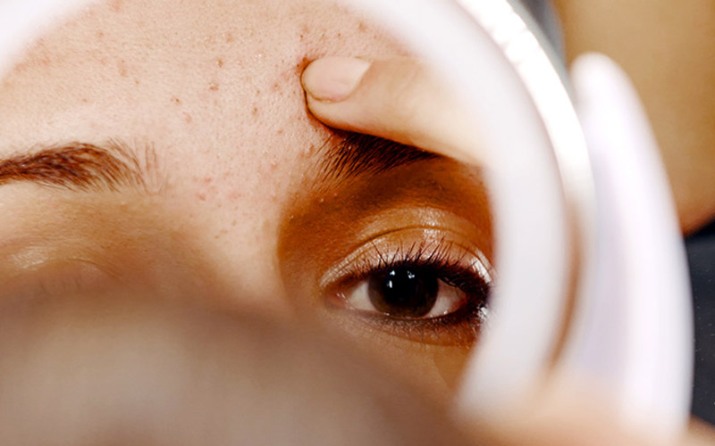 درمان جوش صورت