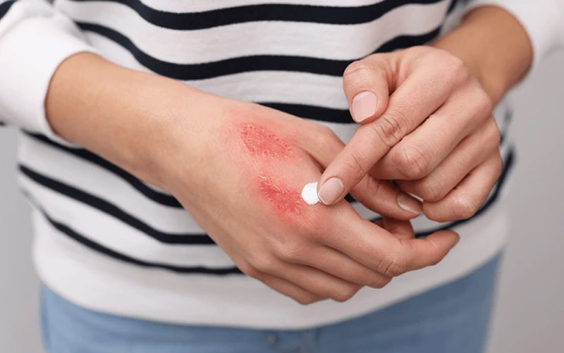 راهنمای خرید بهترین کرم ترمیم کننده سوختگی؛ خداحافظی با جای زخم و اسکار