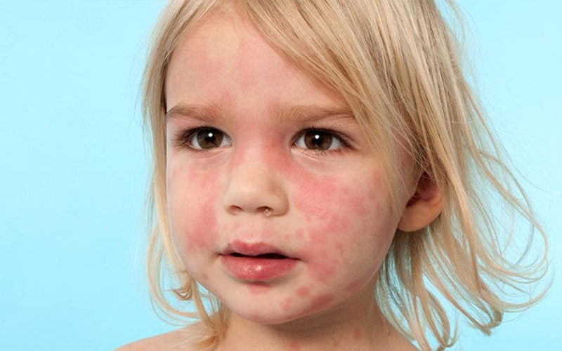 درمان کهیر با نئوتادین