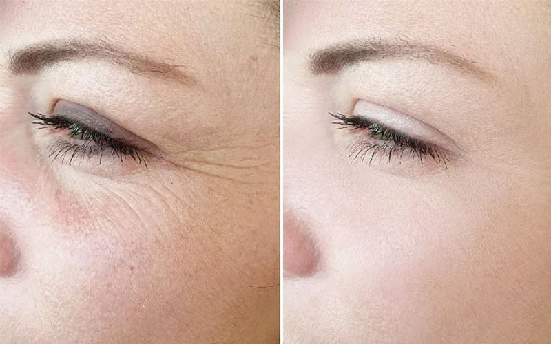 درمان چروک صورت