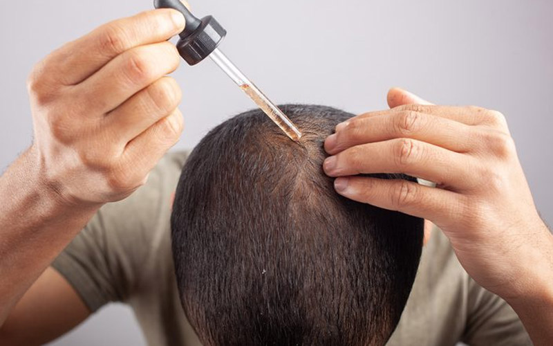 نحوه استفاه ماینوکسیدیل