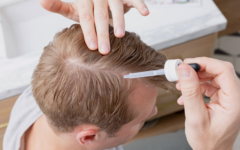 ماینوکسیدیل و ریزش مو