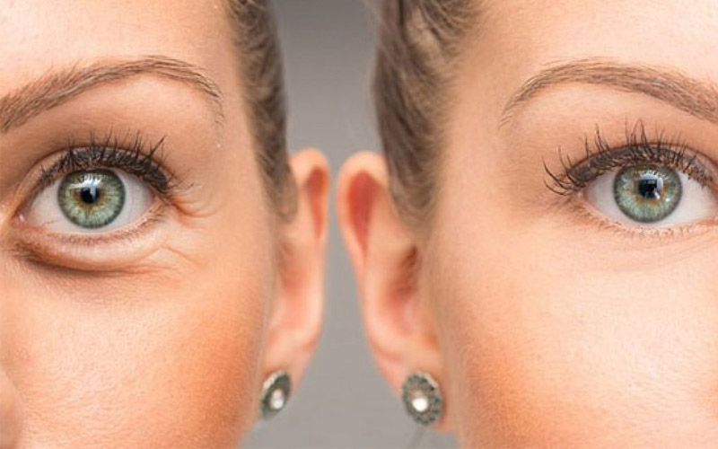 راهکار انتخاب بهترین کروم دور چشم