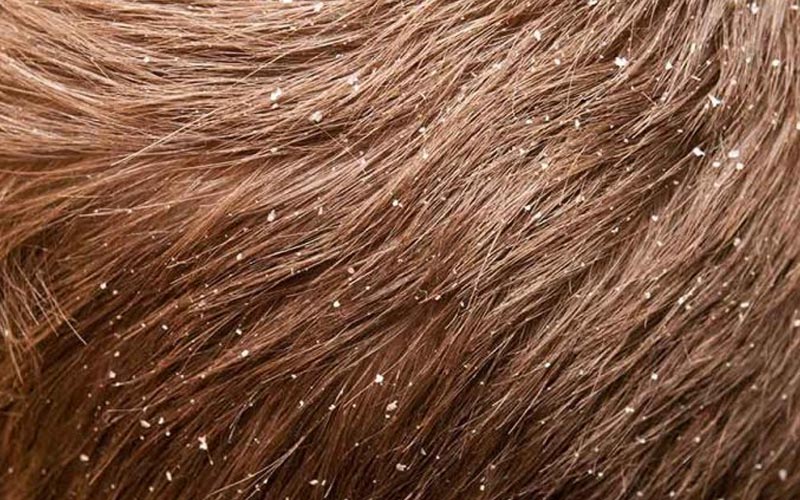 بهترین شامپو ضد شوره