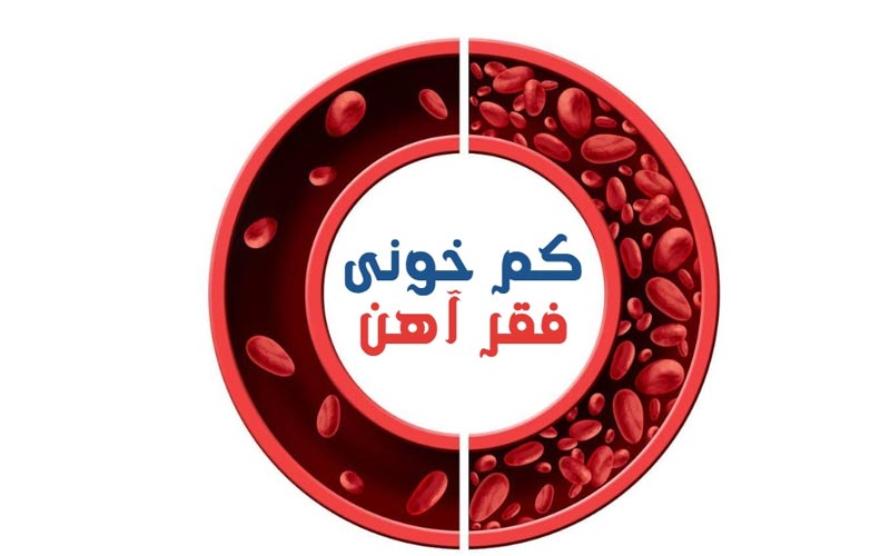 کم خونی فقر آهن چیست