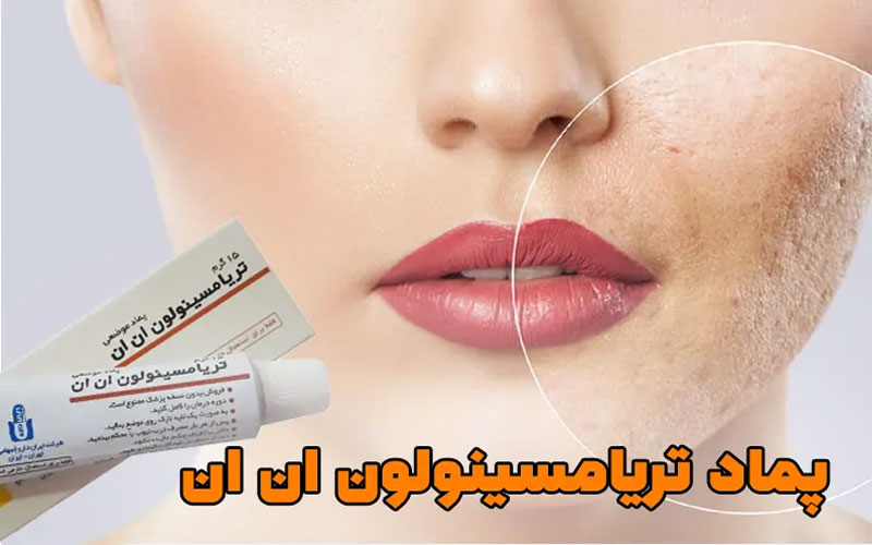 پماد تریامسینولون برای لک صورت