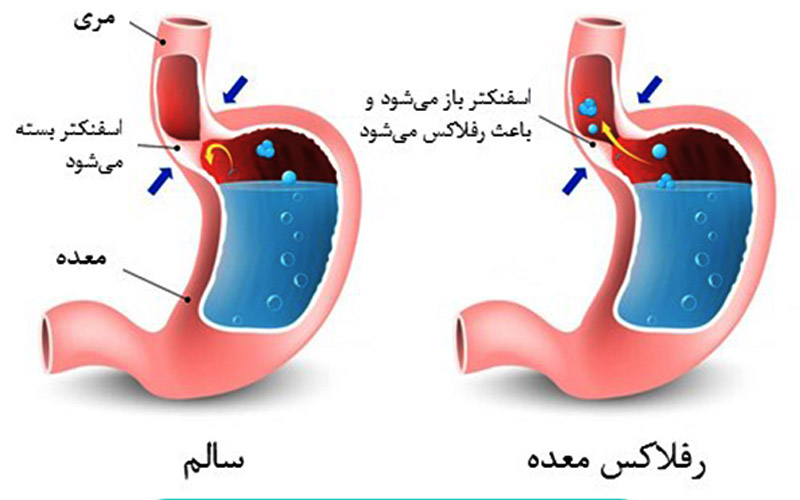 رفلاکس معده