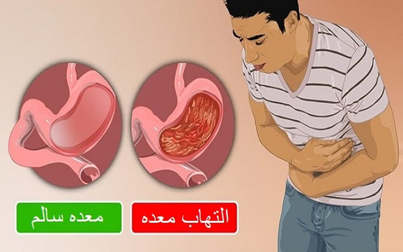 ورم معده