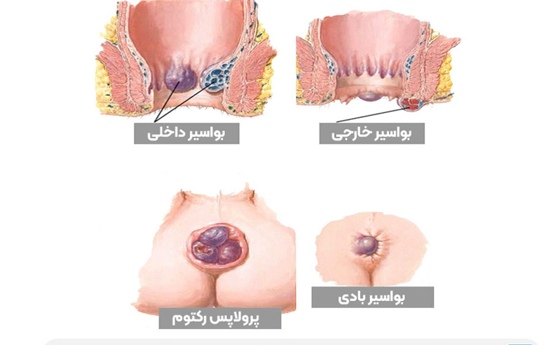 انواع هموروئید